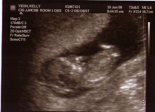 10 weeks pregnant. Kelly is 12 weeks pregnant!